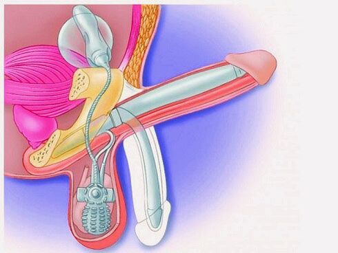 Ingrandimento del pene con protesi peniena